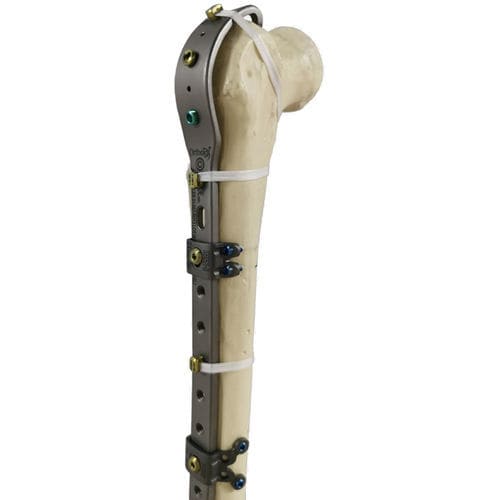 股骨假体周围骨折加压接骨板 - Ortholox®  - Ortolog Medikal - 近端 / 远侧 / 锁定