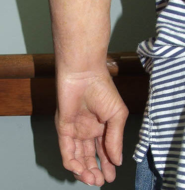 手部整形假体 - Medical Art Prosthetics - 成人