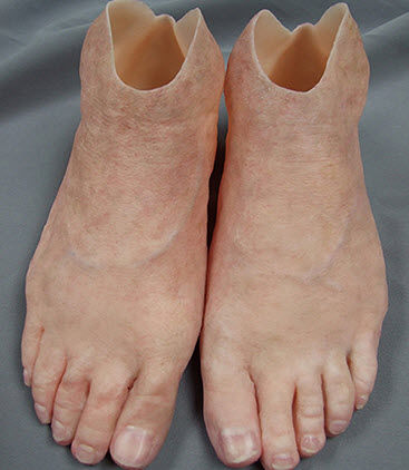 脚整形假体 - Medical Art Prosthetics - 成人