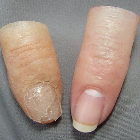 手指整形假体 - Medical Art Prosthetics - 成人