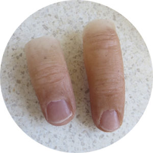 手指整形假体 - Northern Prosthetics - 成人