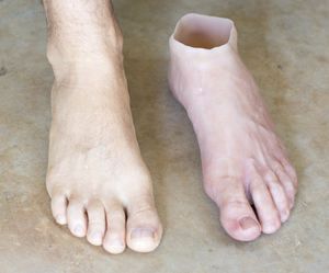脚整形假体 - Northern Prosthetics - 成人