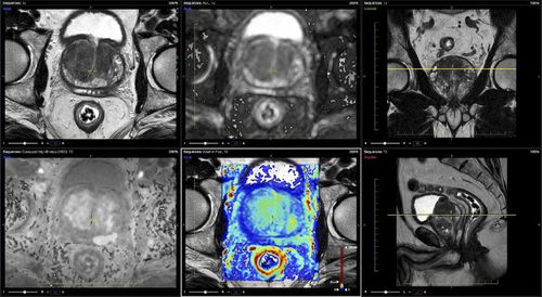 核磁共振MRI软件 - Advantis Medical Imaging - 泌尿科 / 分析 / 报告