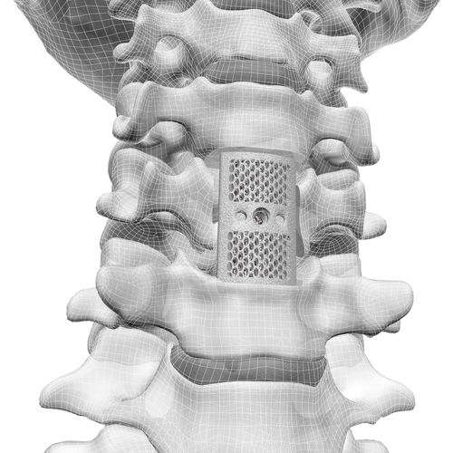 颈椎脊椎假体 - F3D - Corelink Surgical - 3D印刷
