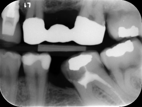 龋探测软件 - ORCA DENTAL AI - 图像分析 / 诊断 / 临床