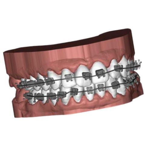 正畸软件 - Ubrackets - Coruo - CAD / 3D 打印 / Windows