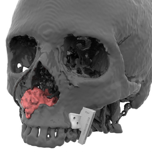 上颌面重建截骨导向器 - Kune Implants