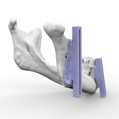 上颌面重建截骨导向器 - RMP - Kune Implants