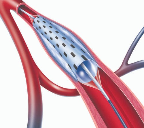 PTA球囊导管 - PolarCath  - Nucryo Vascular - 腘窝下动脉 / 股动脉 / 髂动脉