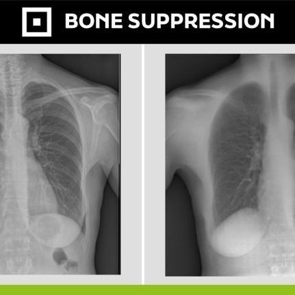 医用软件 - Bone Suppression - Digitec - 放射学 / 诊断 / 后处理