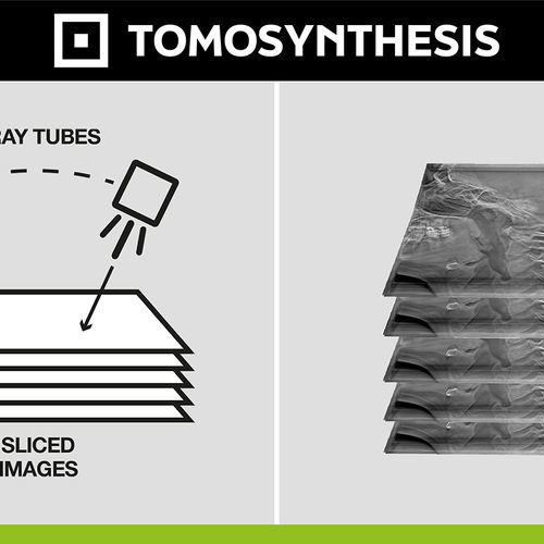 医用软件 - Digital Tomosynthesis - Digitec - 放射学 / 诊断 / 后处理