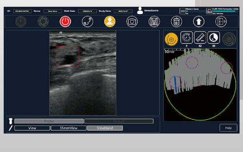超声波成像软件 - BR-FHUS Navigation™ - TaiHao Medical - 查看 / 诊断 / 乳腺癌筛查