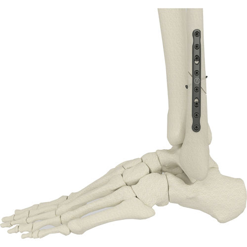 腓骨截骨术固定板 - PK-SFP series - WishBone Medical - 中间 / 未锁定 / 金属