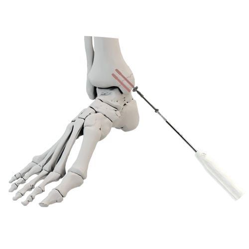 踝部关节螺钉 - WishBone Medical - 引流管 / 钛 / 皮层