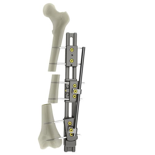 股骨外固定架 - UniX®  - WishBone Medical - 管状