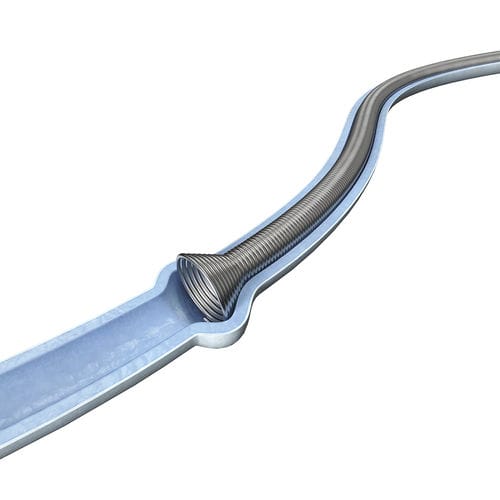 输尿管支架 - SURSM series - Surgsci Medical - 金属