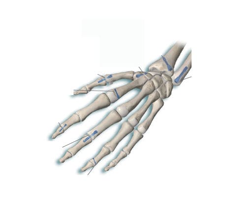 掌骨加压接骨螺钉 - Delphos Implants - 手指骨 / 无头 / 金属