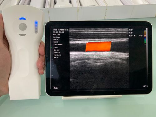 手持式B超机 - CL - Beijing iTrason Technologies - 妇产科用超声成像 / 腹腔和盆腔超声成像 / 用于泌尿科超声检查