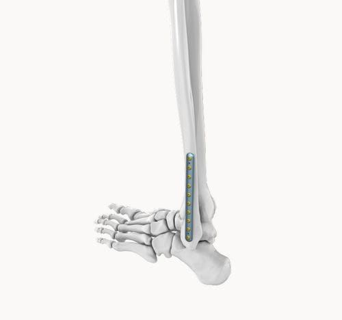 腓骨加压接骨板 - EDF 010 - Eonex Medical - 远侧 / 锁定 / 金属