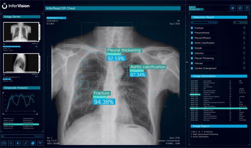 分析软件 - DR Chest - Beijing Infervision Technology Co. Ltd. - 可视化 / 报告 / 医用