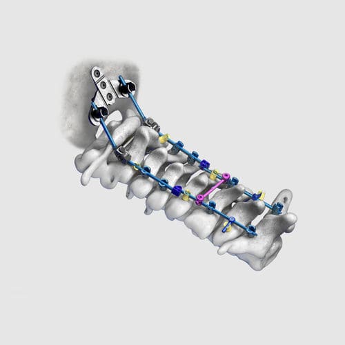 枕颈脊柱内固定系统 - Wuxi Betta Medical Technology - 后入路