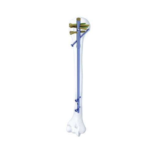 肱骨髓内钉 - SHGK - Chongqing FWS Medical Device - 近端固定 / 骺端固定 / 金属