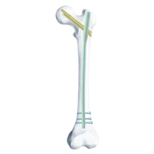 股骨髓内钉 - SGG - Chongqing FWS Medical Device - 钛
