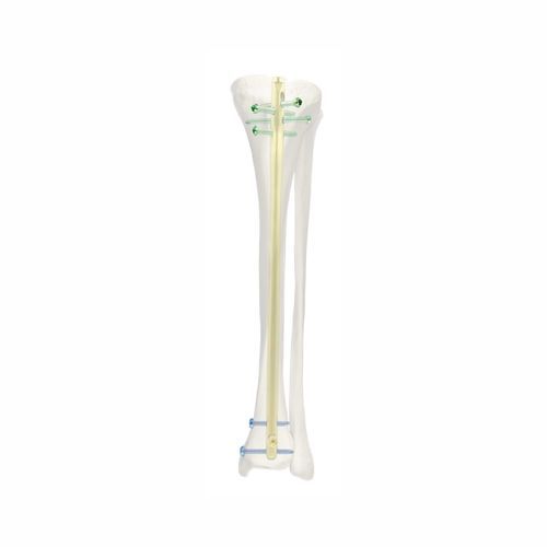 胫骨髓内钉 - SJGK - Chongqing FWS Medical Device