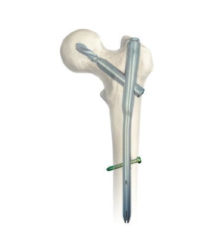 股骨髓内钉 - SGM - Chongqing FWS Medical Device - 近端固定 / 钛