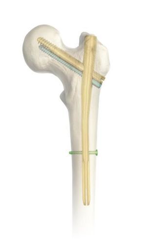 股骨髓内钉 - SGM - Chongqing FWS Medical Device - 近端固定 / 金属