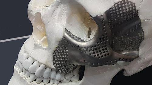 定制眶部种植体 - OrthoCMF - Orthoscape - 不可吸收