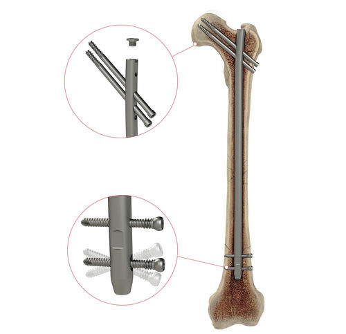 股骨髓内钉 - AS.AFN.400 - Ases Orthopedics - 近端固定 / 远端固定 / 直