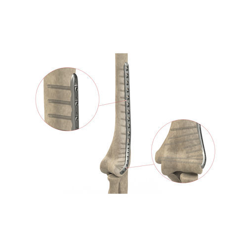 肱骨加压接骨板 - AS.E.021 - Ases Orthopedics - 远侧 / 侧面 / 锁定