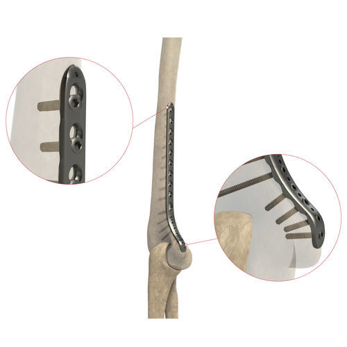 肱骨加压接骨板 - AS.E.020 - Ases Orthopedics - 远侧 / 中间 / 锁定