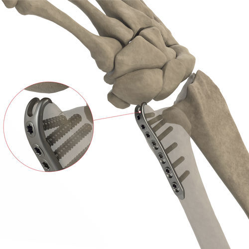 尺骨加压接骨板 - AS.W.016 - Ases Orthopedics - 远侧 / 锁定 / 未锁定