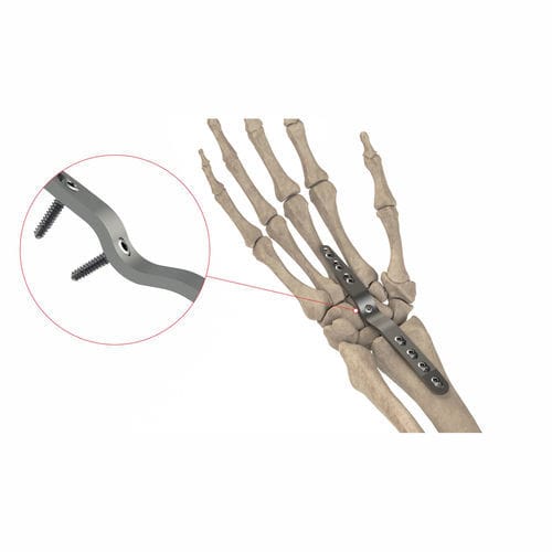 手腕关节固定板 - AS.W.074 - Ases Orthopedics - 背部 / 锁定 / 未锁定