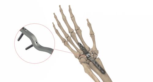 腕骨加压接骨板 - HC Artrodesis LP - Ases Orthopedics - 锁定