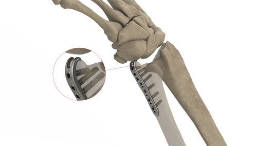 尺骨加压接骨板 - Styloid LP - Ases Orthopedics - 锁定