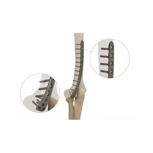 肱骨加压接骨板 - Ases Orthopedics - 远侧 / 后外侧 / 锁定