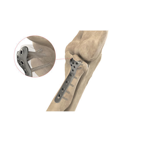 桡骨加压接骨板 - Ases Orthopedics - 锁定