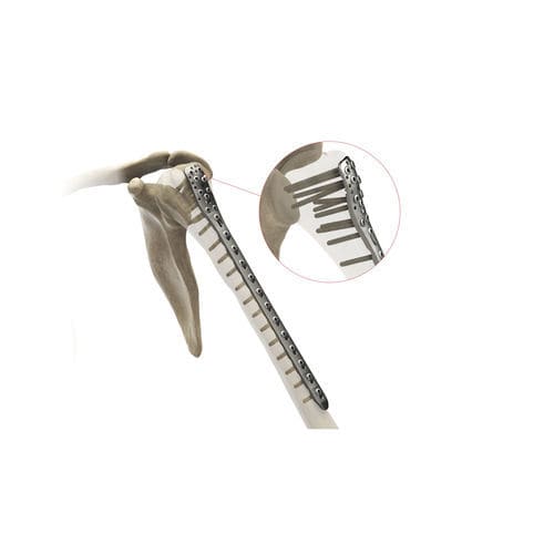 肱骨加压接骨板 - Ases Orthopedics - 近端 / 锁定