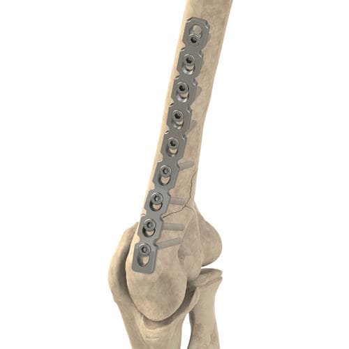 骨盆加压接骨板 - Ases Orthopedics - 锁定