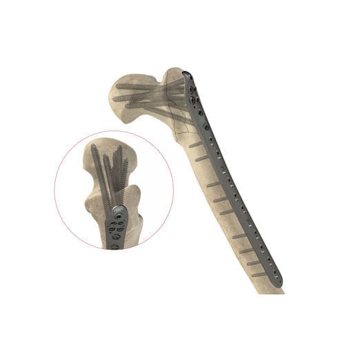 股骨加压接骨板 - Ases Orthopedics - 近端 / 锁定