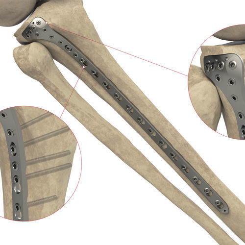 胫骨加压接骨板 - Ases Orthopedics - 近端 / 侧面 / 锁定