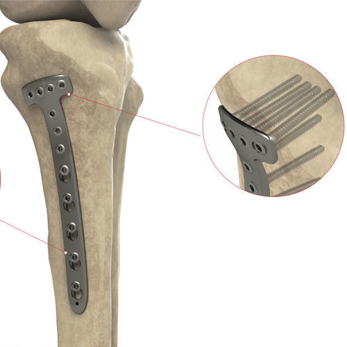 胫骨加压接骨板 - Ases Orthopedics - 近端 / 中间 / 锁定