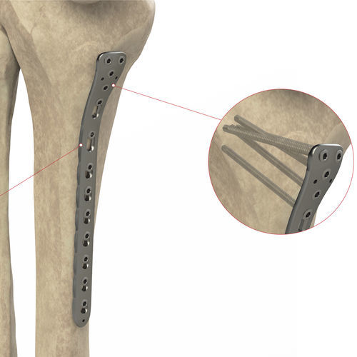 胫骨加压接骨板 - Ases Orthopedics - 近端 / 中间