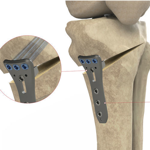 胫骨加压接骨板 - Ases Orthopedics - 锁定
