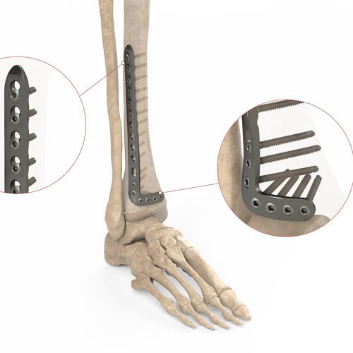 胫骨加压接骨板 - Ases Orthopedics - 远侧 / 前外侧 / 锁定
