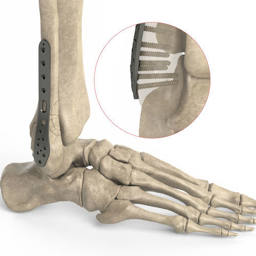 腓骨加压接骨板 - Ases Orthopedics - 远侧 / 侧面 / 锁定