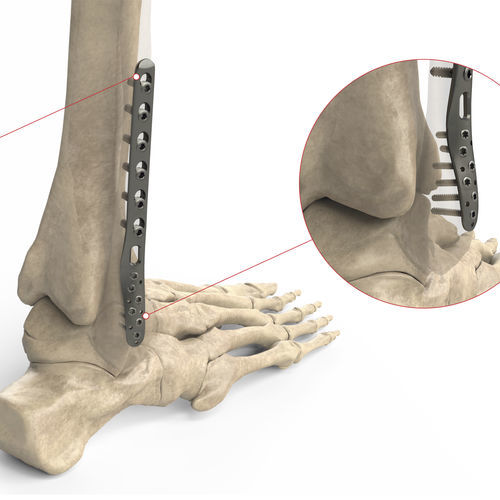 腓骨加压接骨板 - Ases Orthopedics - 远侧 / 侧面 / 锁定